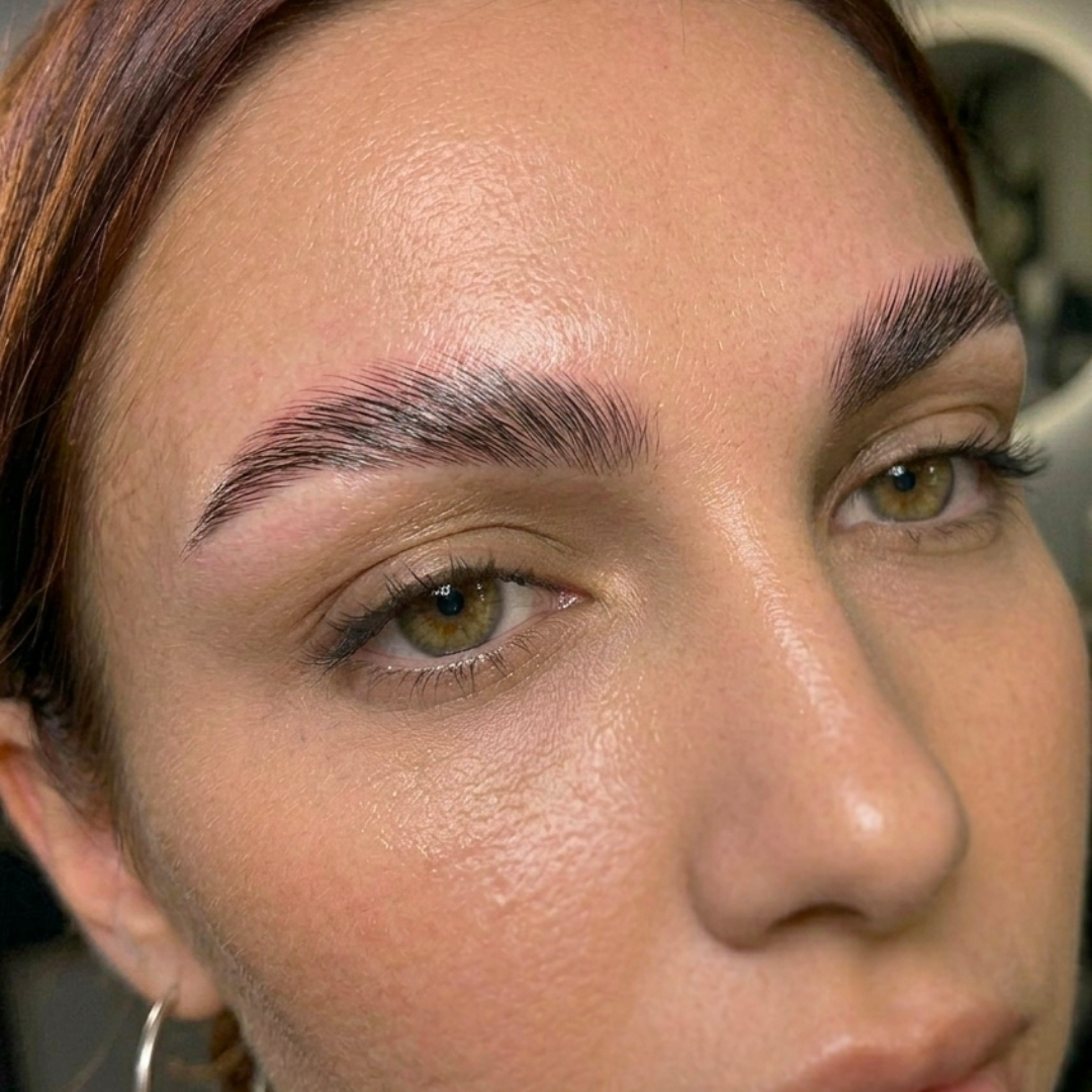 Brow Lift